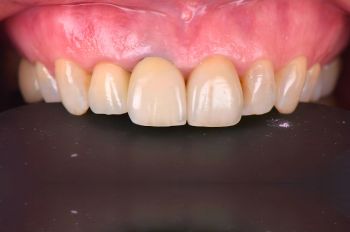 After -Moltons Dental