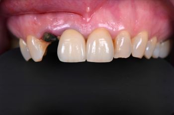 Before - Moltons Dental