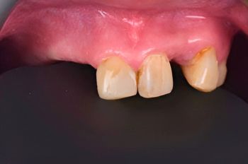 Before - Moltons Dental