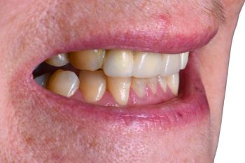 After -Moltons Dental