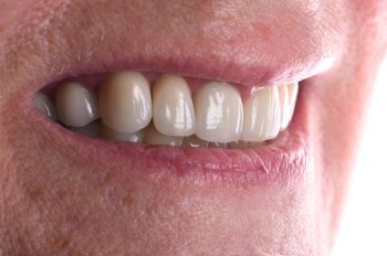 Before - Moltons Dental