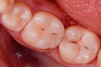 After -Moltons Dental