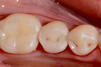 After -Moltons Dental