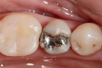 Before - Moltons Dental