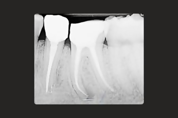 After -Moltons Dental