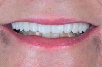 After -Moltons Dental