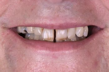 Before - Moltons Dental