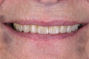 After -Moltons Dental