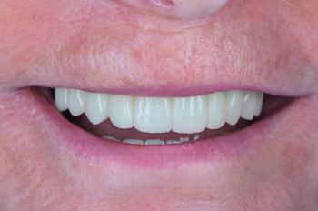 After -Moltons Dental