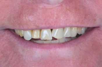 Before - Moltons Dental