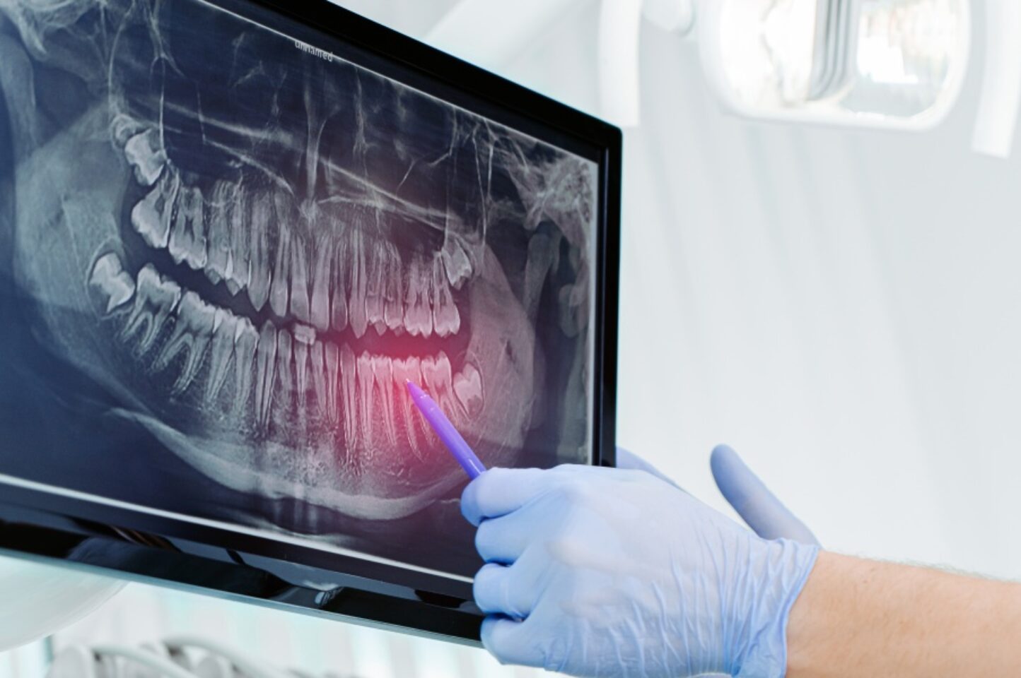 Blog Inner - Moltons Dental